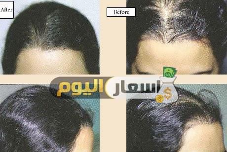 Photo of اسعار زراعة الشعر في تركيا 2024