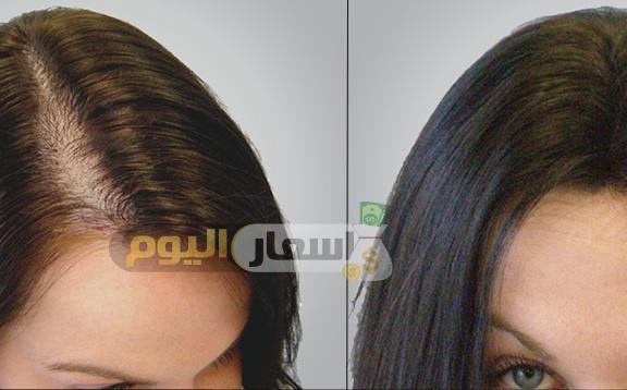 تكلفة زراعة الشعر في مصر 2018