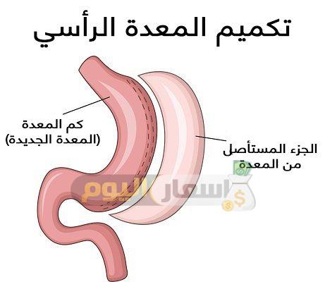 سعر عملية تكميم المعدة في مصر 2018