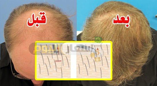 Photo of تكلفة زراعة الشعر 2024 اخر تحديث للاسعار